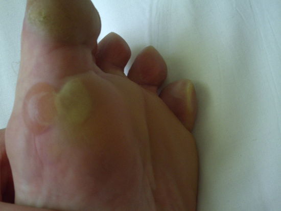 ...so koennen Fuesse naemlich nach solchen Maerschen aussehen...ich versuch ab morgen wieder meine Wanderschuhe zu tragen!!