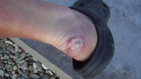 heute pflege ich noch etwas meine blutigen, sooooo schmerzenden(haha!) Fuesse..., nee mal im Ernst, ich geh bald aufm Fleisch....BBQ Sauce dazu bitte....