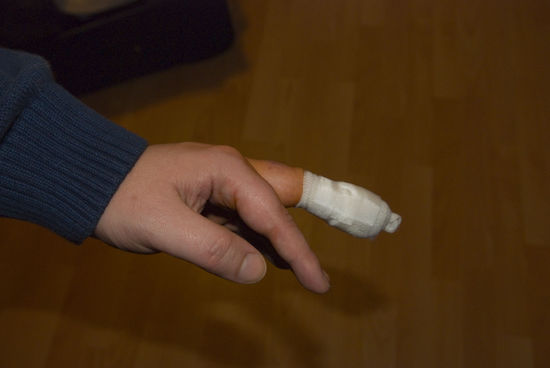 Zoom des verletzten Fingers für die besonders Interessierten ; )