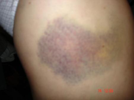 Natalie's Blauerfleck