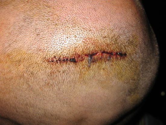 Schuld war nur die blöde Brücke gg. Achja bis ins nächste Spital hätten wir 4 Stunden benötigt, drauf gepfiffen, ist schon wieder gut 