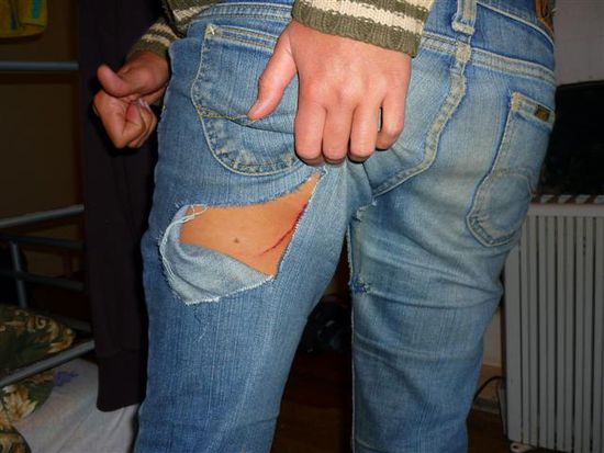 gut gemacht! hab immer noch ne narbe...toll...