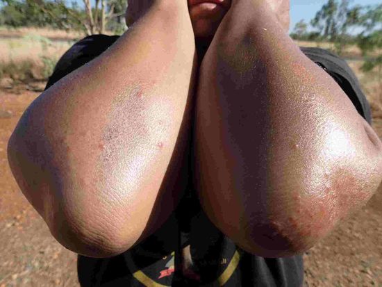 Ich habe viele viel Stiche von was auch immer auf den Ellenbögen und die jucken ganz grässlich