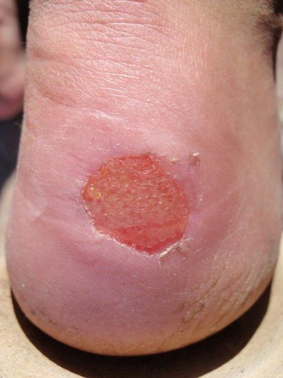 Ein grosses Exemplar an meinem Fuss 