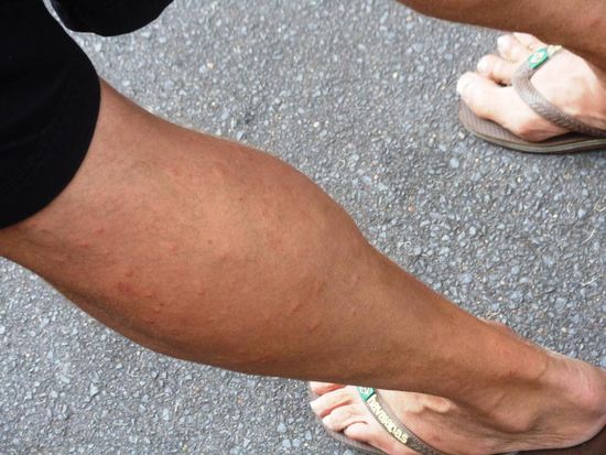 Weiss nicht, ob man all die Moskitostiche sieht. Aber an dieser Wade gibt es über einhundert Stiche - und das alles innerhalb von ein paar Stunden -- gut kratz!!