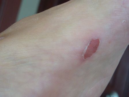 Seit Wochen wieder einmal die Schuhe montiert und schon gabs die ersten Blasen..