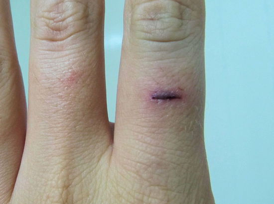 Der Schnitt einen Tag später. Im ersten Moment dachte ich, der Finger wäre amputiert, aber das Rotorblatt ist anscheinend nur bis zum Knochen gekommen. Aktuell (fast vier Monate später) kann man immer noch einen Huckel unter der Haut spüren und ich habe an der Stelle nun eine dezente Narbe. So habe ich zumindest ein dauerhaftes (und noch dazu kostenloses) Souvenir von Samoa!