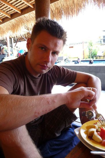 Man beachte den "Ausschlag" auf seinem Arm. Das passiert, wenn man unter Wasser nicht vorsichtig ist und eine Feuerkoralle streift