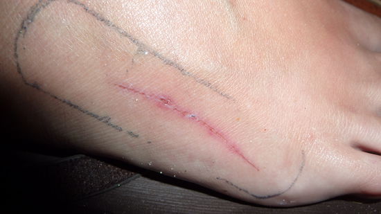 Das war Ellis schlimme Verletzung. Elli: "War schlimmer als es aussieht, Foto wurde erst 3 Tage spater gemacht." Naddel: "Ohhhhhhhhhhhh"