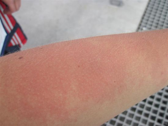 Autsch, böse Qualle!