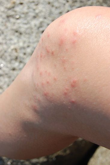 Mein linkes Knie! Hat nur ein paar Minuten abends unter der Decke rausgeschaut und wurde mit ca. 80 Stichen bestraft! (die Fliegenstiche spürt man gar nicht)