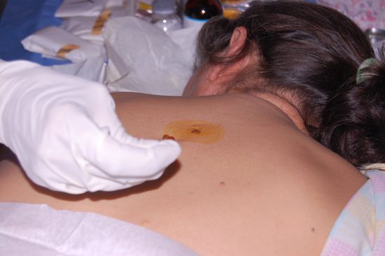 Auch die Stelle rund um das zu entfernende etwas wird großflächig mit Antiseptikum eingestrichen, um jegliche Infektion auszuschließen.