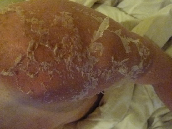 hier noch ein Bild von meiner Haut, die sich nach dem Sonnenbrand vom Tubing abloest
mein Bett und das ganze Zimmer sah nach 5 Tagen wie eine Schlangenfarm waehrend der Häutungszeit aus, ich frage mich was die Putzfrauen anschliessend gedacht haben