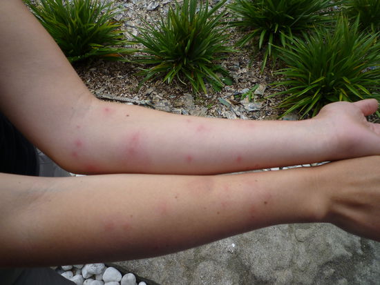 Ja, das ist das wunderschöne Resultat der Sandflys. zu beachten wäre der blaue Fleck am rechte Arm, verursacht durch so ein überaus reizendes Fliegebiest