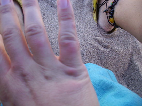 meine zerstochene hand