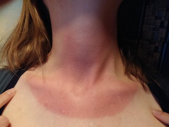 Und das ist nur ein Teil vom Sonnenbrand...