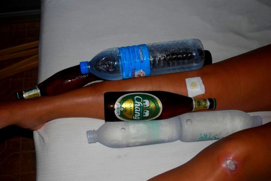 Kühlen bis der Arzt kommt... und das kann auf Koh Tao sehr lange dauern.