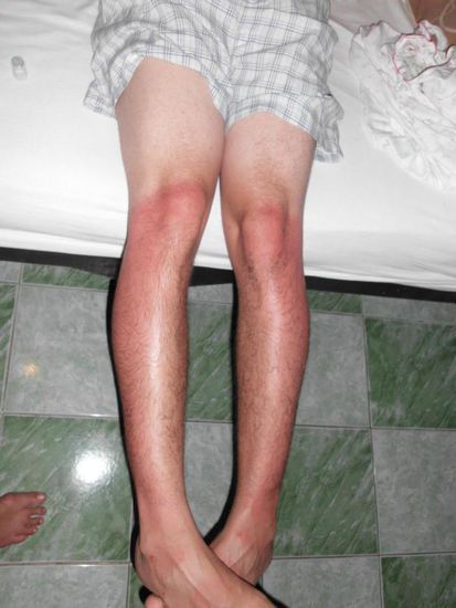 Nein- seine Beine wurden nicht in kochendes Wasser gesteckt, aber 3 Stunden pure Sonne haben ihre Spuren hinterlassen. Aua...