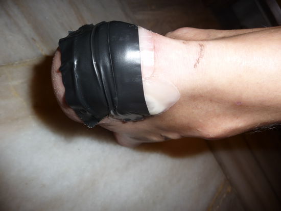 Schlimme Blasen. Gekriegt auf der letzten Wandwerung im Jura, kurz vor der Abreise. Olaf wollte noch seine neuen Wanderschuhe einlaufen, war jedoch ein grober Fehler. Mittlerweile alles wieder gut.