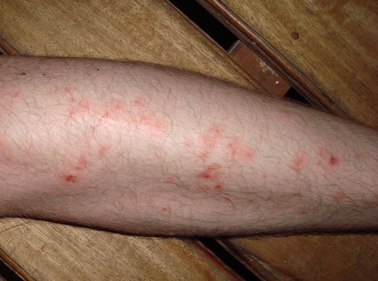 Viele, viele Begbugbisse, die wirklich wie Hölle jucken 