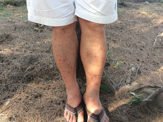 Unglaublich diese Stiche oder Bisse