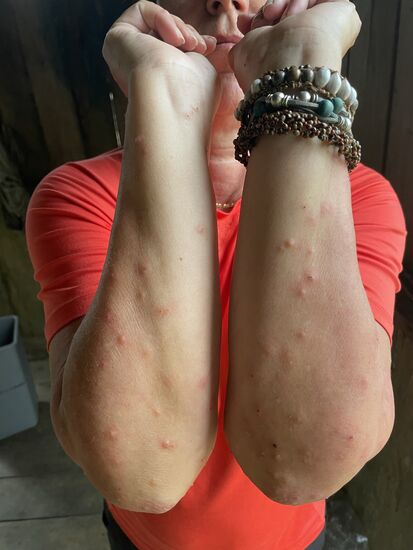 Noch mehr Ausschlag oder Stiche