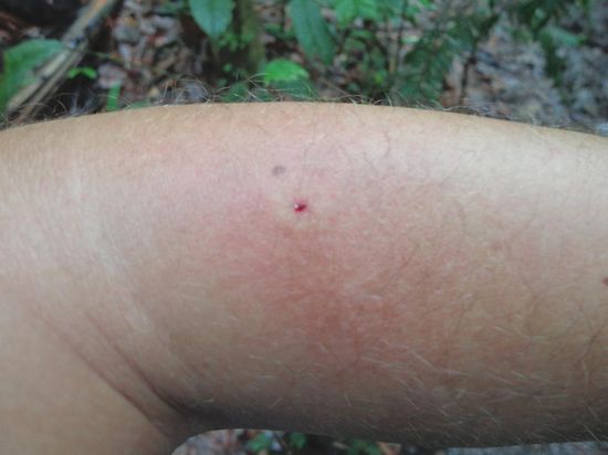 Das war das Resultat - der Stich juckt heute manchmal noch 